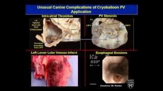 Avoiding Complications During Atrial Fibrillation Ablation  Dr Munger Mayo Clinic [upl. by Patricio274]