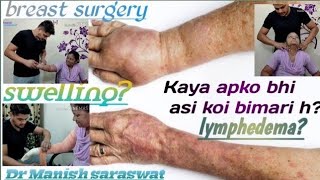 Lymphedema bandaging arm  dr m s prabhakar [upl. by Siana991]