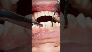 Class V tooth caries composite restoration dentisry [upl. by Darda]