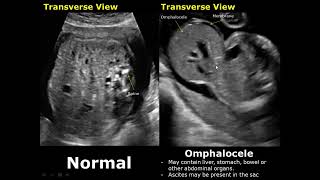 Fetal Bowel Ultrasound Normal Vs Abnormal Image Appearances  Intestine Diseases in Fetus USG [upl. by Eugenia]