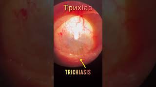 Corneal opacification and trichiasis  Помутніня рогівки і трихіаз  Помутнение роговицы и трихиаз [upl. by Luci]