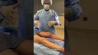 Thigh Lift Surgery After Lipedema Liposuction  Dr Boris Volshteyn [upl. by Gere]