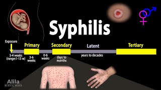 Syphilis  Pathophysiology Diagnosis and Treatments Animation [upl. by Enilhtak10]