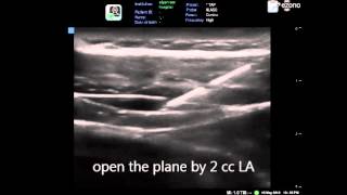 ultrasound guided subcostal TAP block [upl. by Aiz]