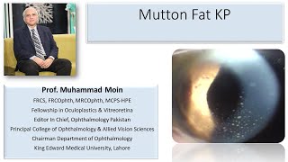 Mutton Fat Keratic Precipitates [upl. by Asiralc]