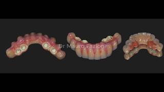 All on four DentsplySirona Ankylos and Trilor by Bioloren [upl. by Adialeda]