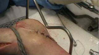 Palm and sole suture on a cadaver foot [upl. by Eurydice850]