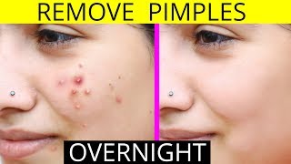 How To Remove Pimples Overnight  Acne Treatment  Anaysa [upl. by Eikciv]