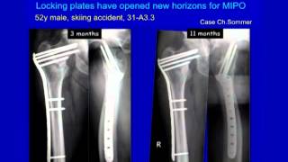 Complex Proximal Femur Fractures [upl. by Ralyat]