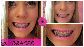 Adult Braces Elastics Powerchain Brackets [upl. by Lillie369]