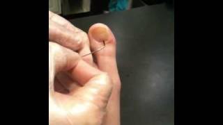 Draining a Subungual blister of toenail [upl. by Relda429]