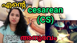 My Cesarean StoryProcedure of CSectionmotherhood [upl. by Kalila]