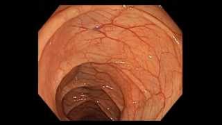 Colonoscopy Channel  Colonoscopy Screening  Excellent quality of colon preparation [upl. by Sineray]