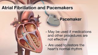 ATRIAL FIBRILLATION The silent threat to your heart healthquot pacemaker surgery [upl. by Isidora]