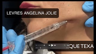 FILLERS TEXAS TECHNIQUE ET LEVRES DANGELINA JOLIE [upl. by Brittni969]