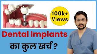 What is the cost of DENTAL IMPLANTS [upl. by Kahcztiy]