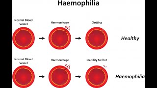 Hemophilia B and its Mutations [upl. by Sotos]