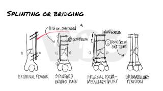 Principles of Fracture Fixation  Orthopedic Basics [upl. by Lucienne]