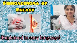 Fibroadenoma of Breast explained in simple language  Female Health  Treatment [upl. by Maxentia]