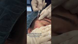 Subcision for Acne Scars of the Cheeks and Temples [upl. by Torin]