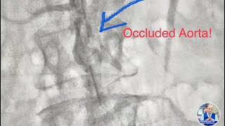 Occluded Aorta infrarenal CTO Revascularization of Aorta and Iliac artery  Lithotripsy amp stent [upl. by Kelton]