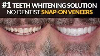 Teeth Whitening SnapOn Veneers  FASTEST Perfect White Smile Solution [upl. by Elleinnod]