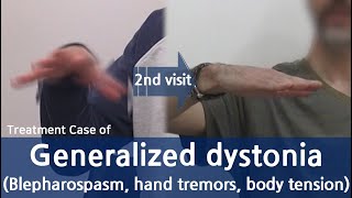 Generalized Dystonia  Cervical dystonia Dysphonia Oromandibular dystonia  전신 디스토니아 치료사례  근긴장이상증 [upl. by Eilyr]