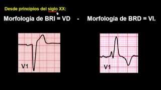 CURSO DE ELECTROCARDIOGRAFIA 48  EXTRASÍSTOLES VENTRICULARES [upl. by Perice]