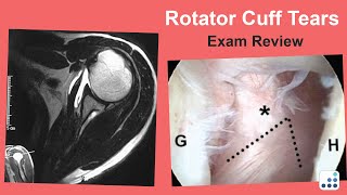 Rotator Cuff Tears Exam Review  William N Levine MD [upl. by Raclima533]