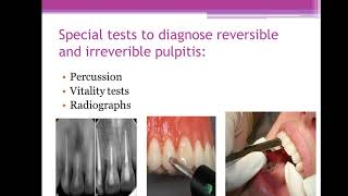 45The difference between reversible pulpitis and irreversible pulpitisMFDSMJDFORE [upl. by Diahann903]