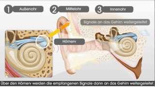 Wie das Gehör und das Hören mit einem CochleaImplantat funktioniert [upl. by Scherle]