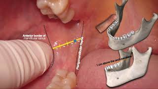 Inferior Alveolar Nerve Block step by step [upl. by Eaned]