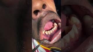 Mandible parasymphyseal fracture surgical outcome l07044611705 l Dr Arindam MandalOmfsjawfracture [upl. by Andromeda]