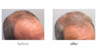 Mens Hair Loss Treatment Finasteride Propecia Minoxidil Rogaine Before and After [upl. by Ahsenrat]