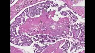 Histopathology BreastDuctal carcinoma in situ [upl. by Annhej358]