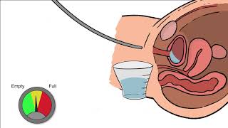 How to remove a urinary Foley catheter [upl. by Enia]