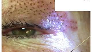 Plasma Skin Rejuventation  Eyelid Lift Using Plasma Pen Pro Technique [upl. by Arraek832]