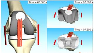 Knee joint kinematics during flexionextension have been analyzed via Multibody Simulation SIMPACK [upl. by Sakiv255]