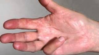 Straightening your fingers and Dupuytrens Contracture [upl. by Akeirahs]