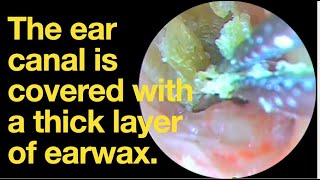 The ear canal is covered with a thick layer of earwaxear wax removal  ear cleaning  ASMR  relax [upl. by Dnalyram826]