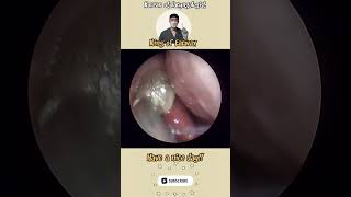 귀지형 콧물 부비동염 축농증 비염 코청소 이비인후과 rhinorrhea rhinitis sinusitis asmr ENT ENTdoctor [upl. by Stoll]