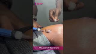 Smooth away keloid scars with Kenalog injections💉✨ at Singhania Skin Clinic [upl. by Muscolo]