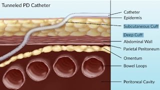 Complications of Peritoneal Dialysis by S Su  OPENPediatrics [upl. by Torosian]