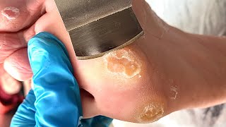 Callus removal from feetampFoot scraping dead skin【Xiao Yan pedicure】stress 617 [upl. by Naenaj]