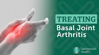 Basal Joint Arthritis [upl. by Kutzer]