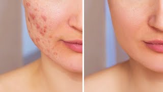 Get Rid of Acne FAST [upl. by Lilla765]