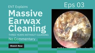 Satisfying Earwax Cleaning 3 Cholesteatoma No Commentary [upl. by Ramar638]