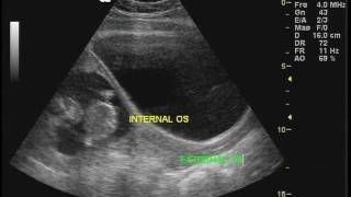 Cervix ultrasound meassurement in a pregnant patient [upl. by Eiramanad]