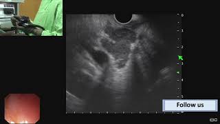 Learning video  Abdominal Lymph nodes linear EUS Dr Vikas Singla [upl. by Alitha583]