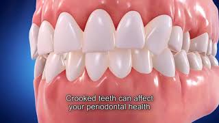 Straight talk on the impact of crooked teeth [upl. by Hanala]